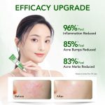 [UPGRADED] Y.O.U AcnePlus Spot Care X with 4D Centella Pionin Rapid Acne Treatment Relieve Breakouts Soothe Skin (15g) hanya RM17.01 di Shopee